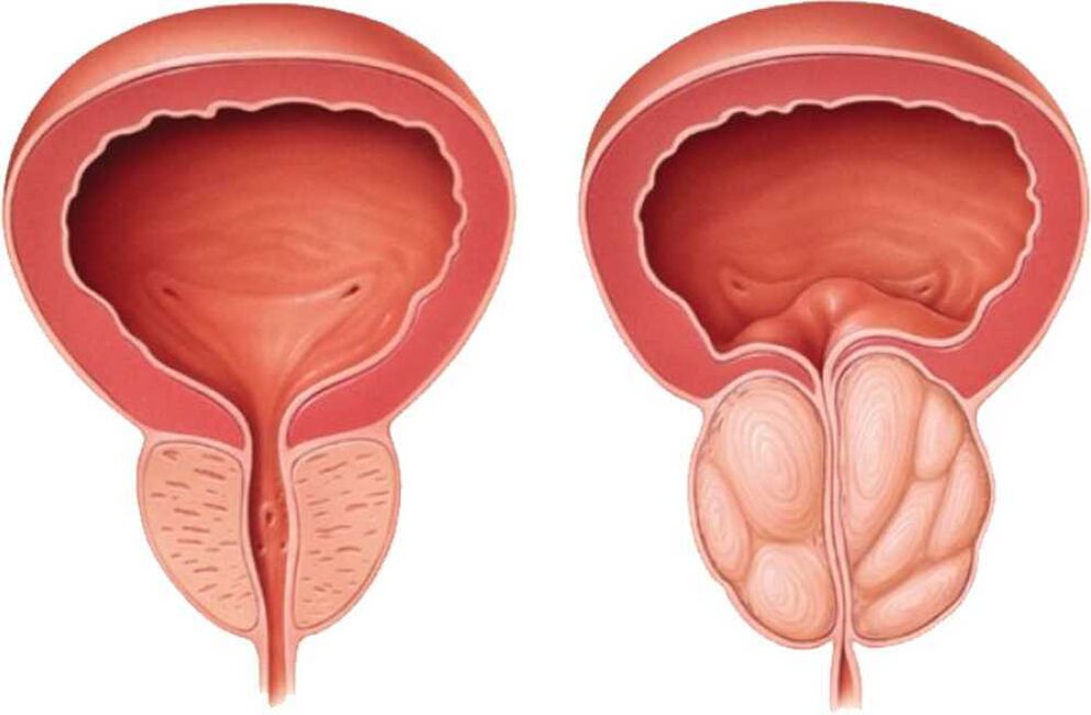 boleča prostata