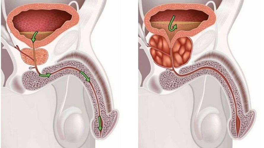 Prostatitis pri moških